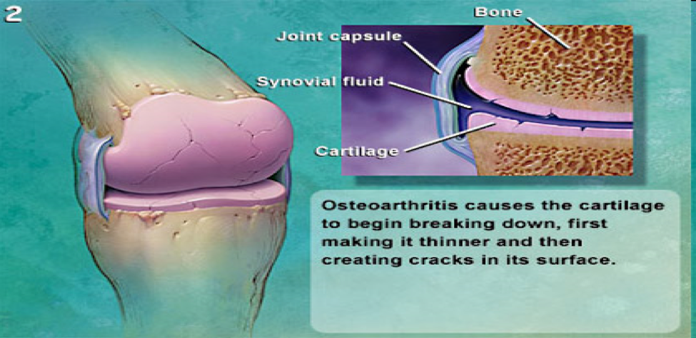 osteo-arthritis