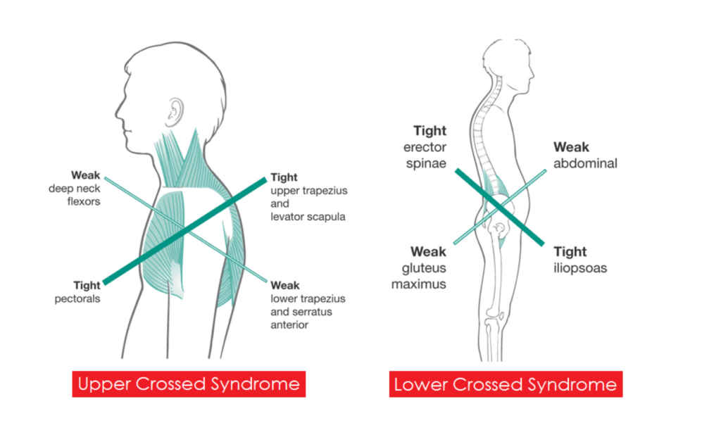 Postural Dysfunction and Exercise Therapy: What are they? - Drummond ...